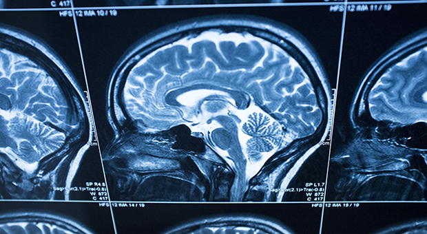 A stock image shows a scan of a brain.