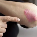 Psoriasis on elbow. Close-up