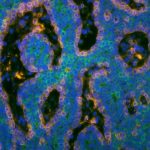 This immunofluorescent image from Allison Cleary and Dr. Edward Gunther shows two distinct populations of cells in red and green that may cooperate in a chimeric tumor. Cleary™s essay, Teamwork: The Tumor Cell Edition, describes her work while in Dr. Edward Gunther™s lab, looking at the role of breast cancer cell subpopulations in tumor development and progression.