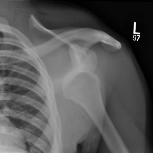 An X-ray image of the left shoulder is seen. The bones of the rib cage are visible at left in the photo, and the upper left arm bone is visible at right.