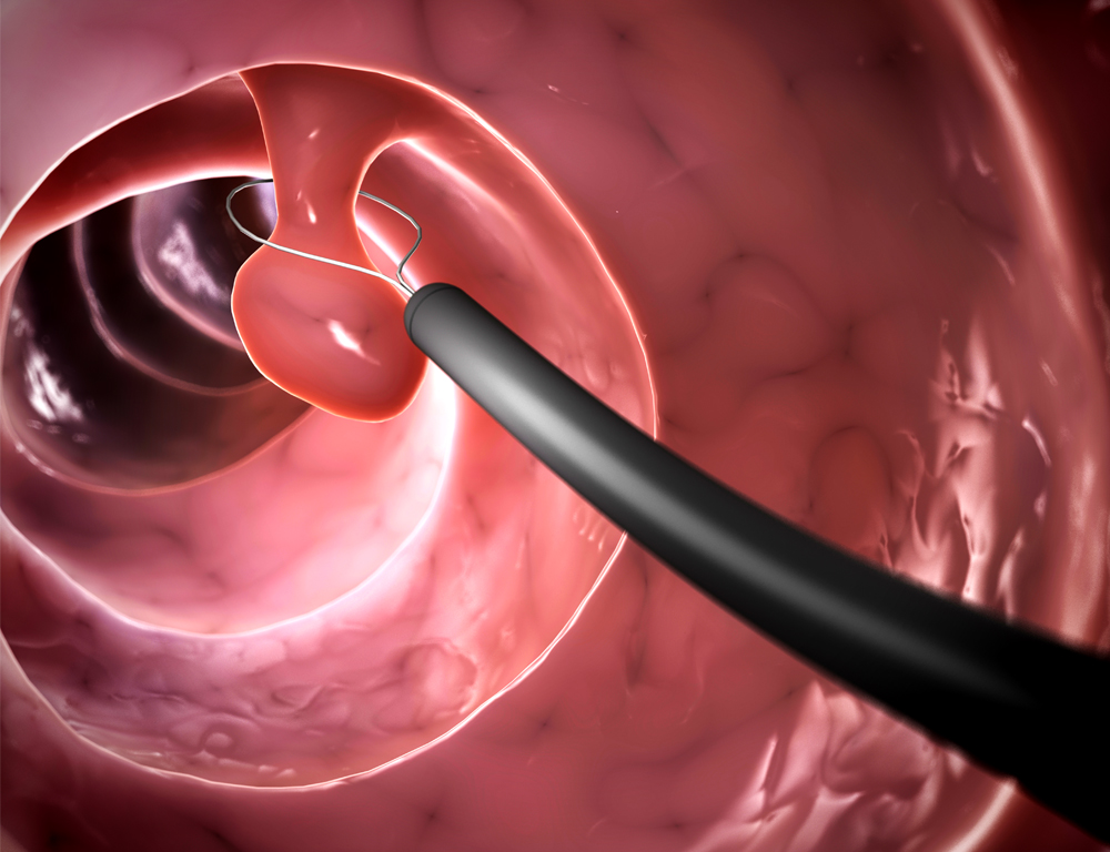 Internal depiction of a polyp being removed from inside of a colon.