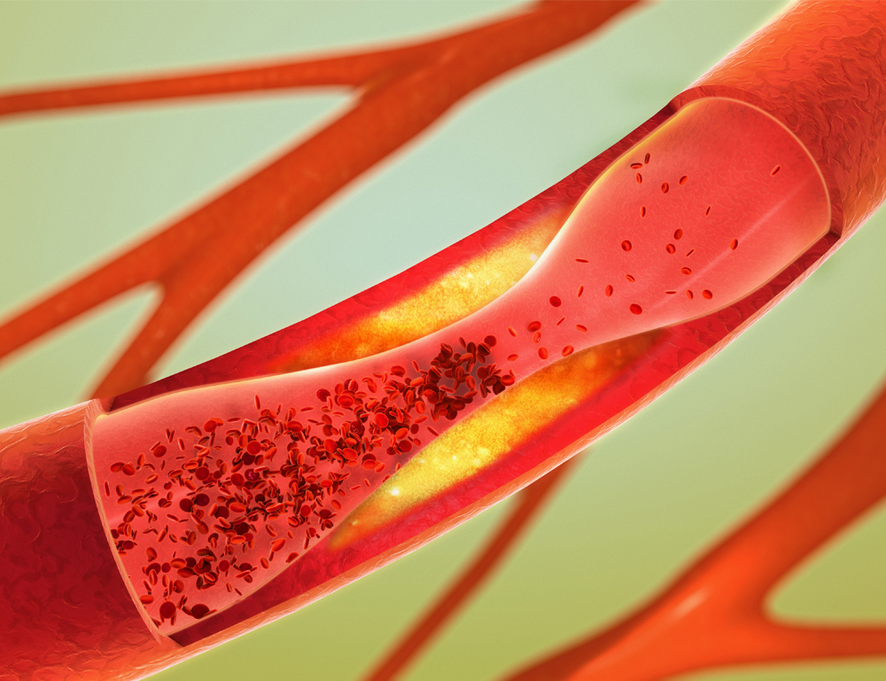 A close-up depiction of arteries, shown in red against a light green background. The largest artery in view has a partial blockage.