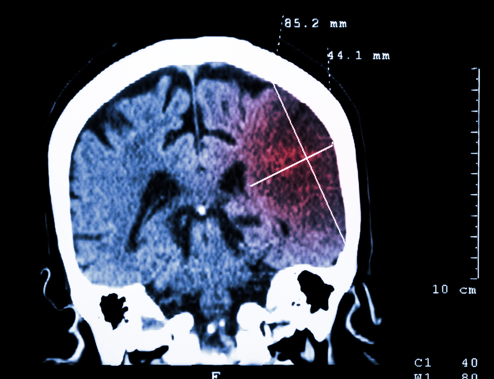 A digital scan depicts the brain in blue, with an area on the right side a shade of red, depicting the site of a stroke.