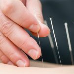 A close-up of a hand placing acupuncture needles in a patient's back.