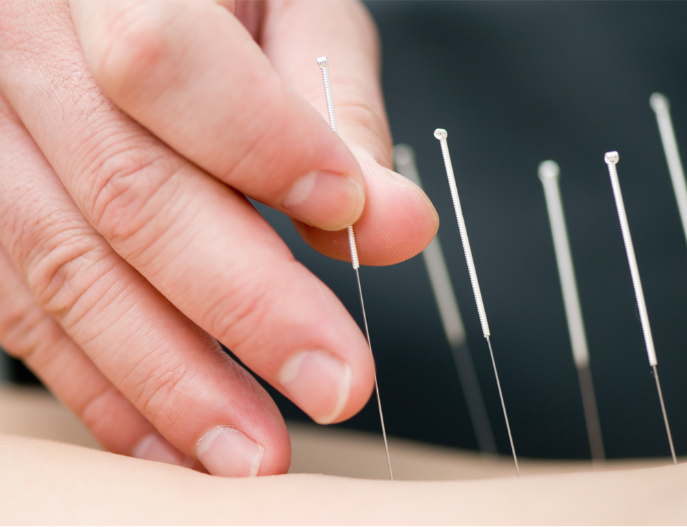A close-up of a hand placing acupuncture needles in a patient's back.