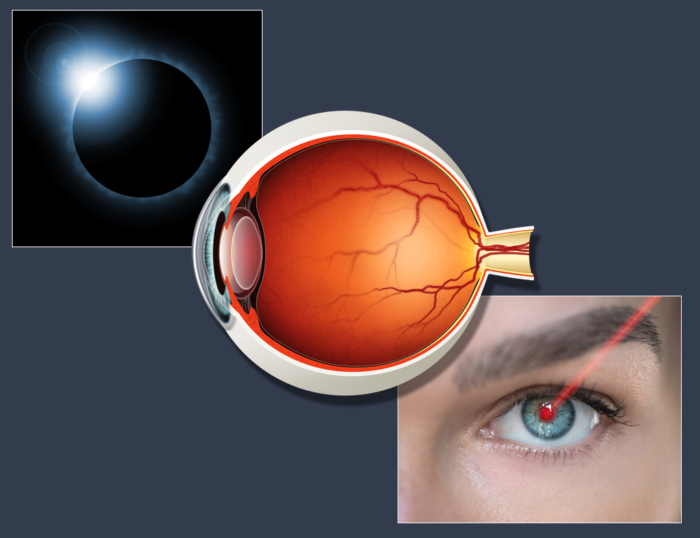 Three overlapping images, one depicting a solar eclipse, one side angle of a retina and the third depicting a red laser shining into an eye.