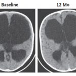 Two scans of an infant's brain appear side-by-side. One is labeled 'Baseline,' the other '12 Months.'