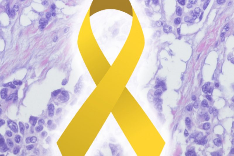 Ask Us Anything About... Sarcoma