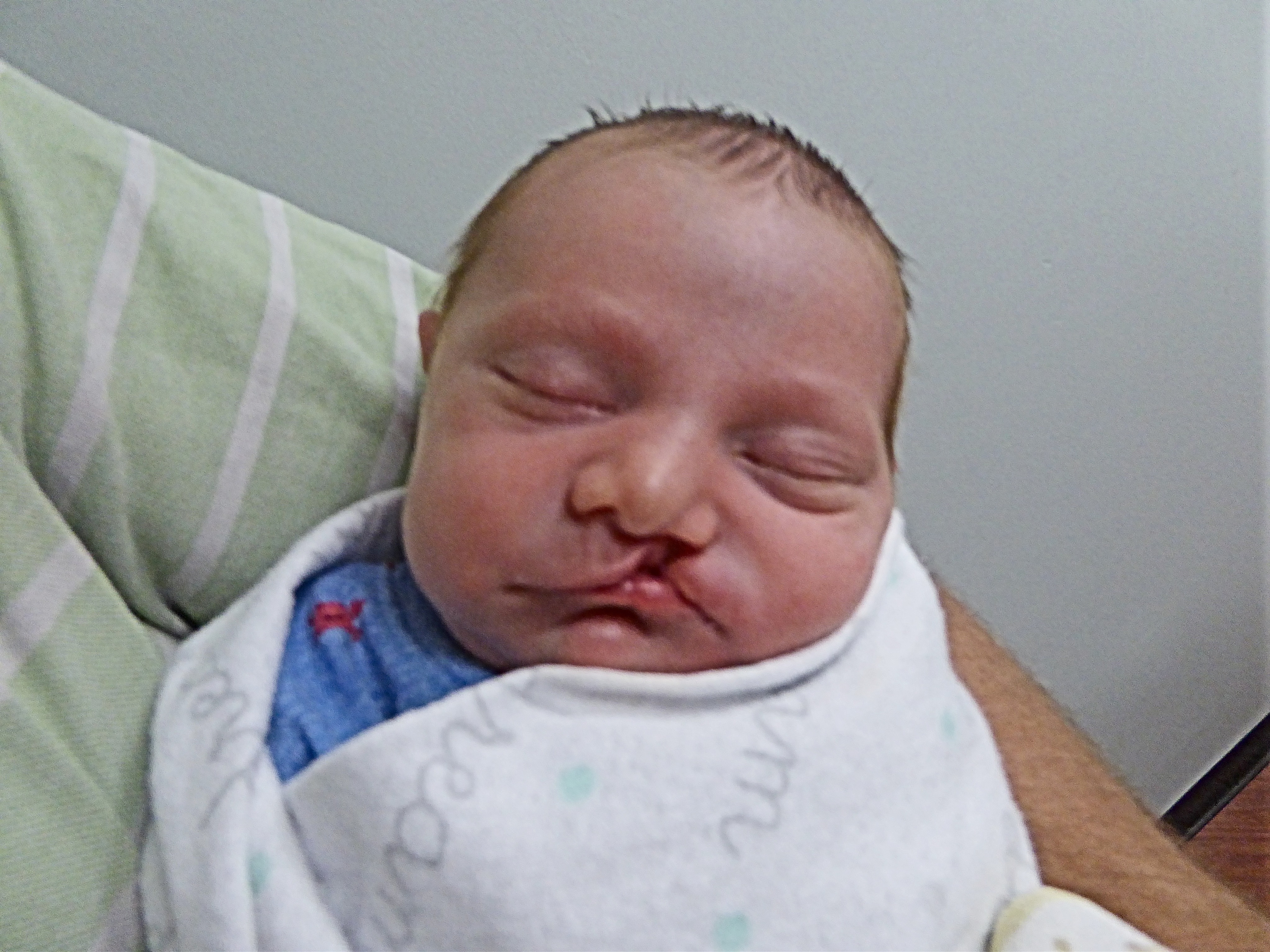 A baby with a cleft lip lies sleeping in a man’s arms. The baby is wrapped in a thin blanket and is wearing pajamas.