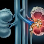 A color illustration of two kidneys, side by side. The one on the right is depicted as a cross-section, and we see several stones inside of it.