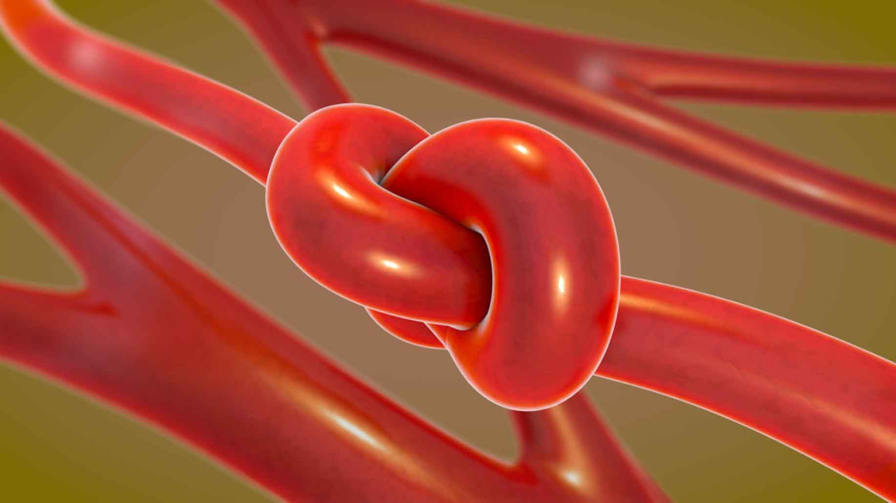 A stylized image of a knotted blood vessel.