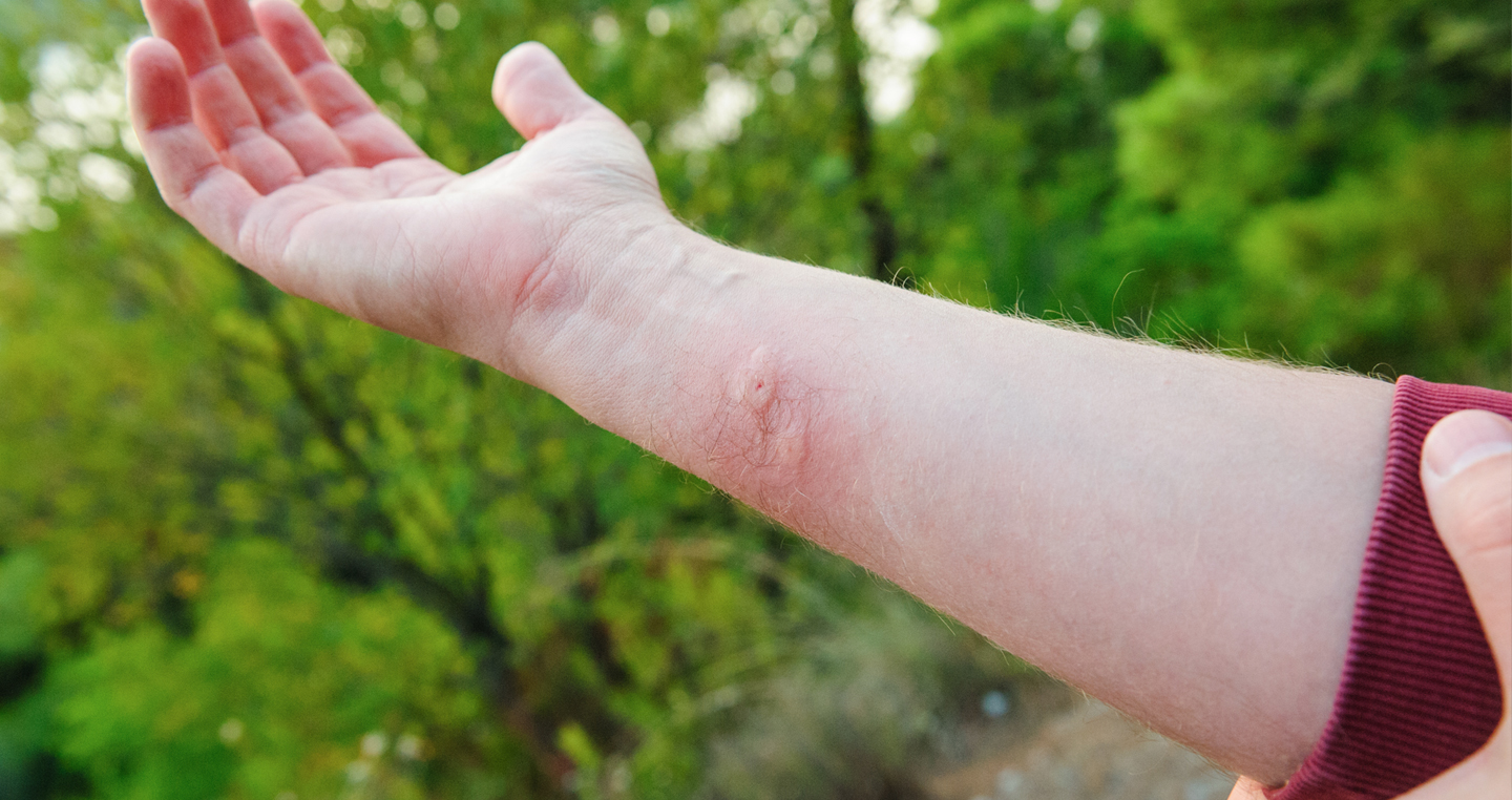 A forearm with a noticeable bug bite.