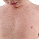 A child’s torso is covered with a rash.