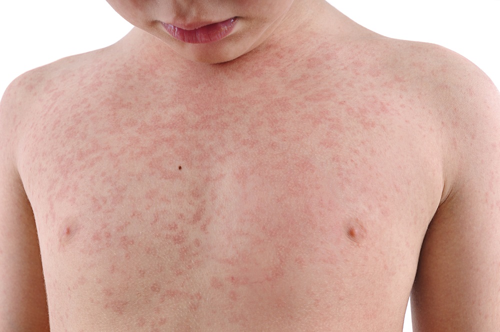 A child’s torso is covered with a rash.