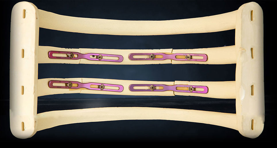 Shown is a scale model of four ribs of a human rib cage with four purple rib fixation devices screwed into two of the ribs to support the bone fractures.