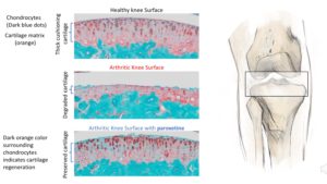 Images of a healthy knee surface, an arthritic knee surface and an arthritic knee surface treated with paroxetine.” 