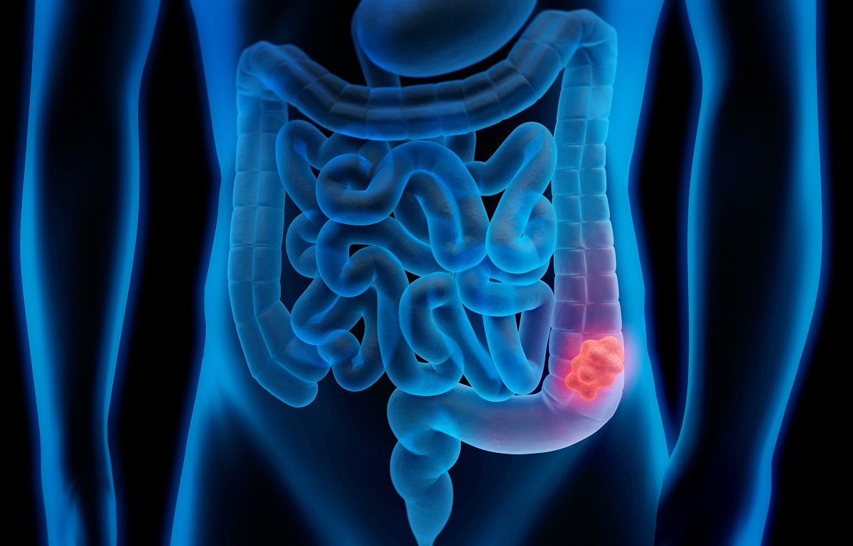 An illustration shows a torso with intestines. A tumor is highlighted.