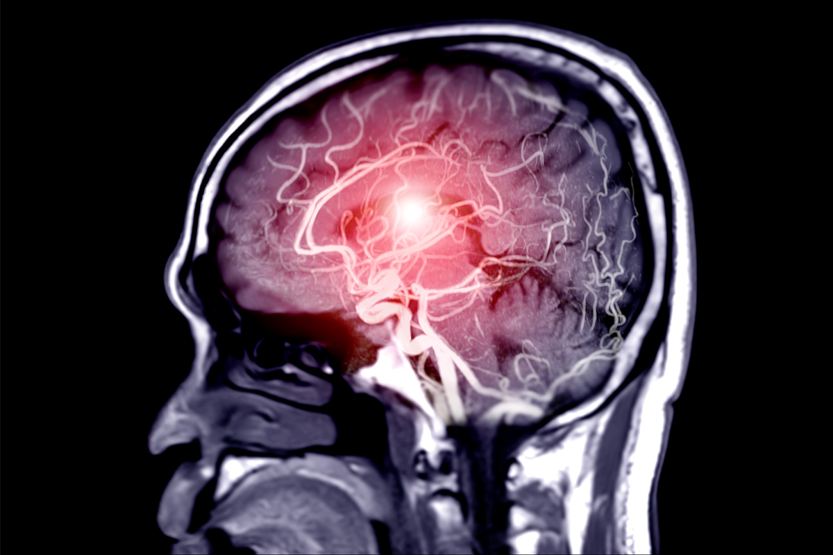 A composite x-ray and illustration depicts a hemorrhagic stroke.