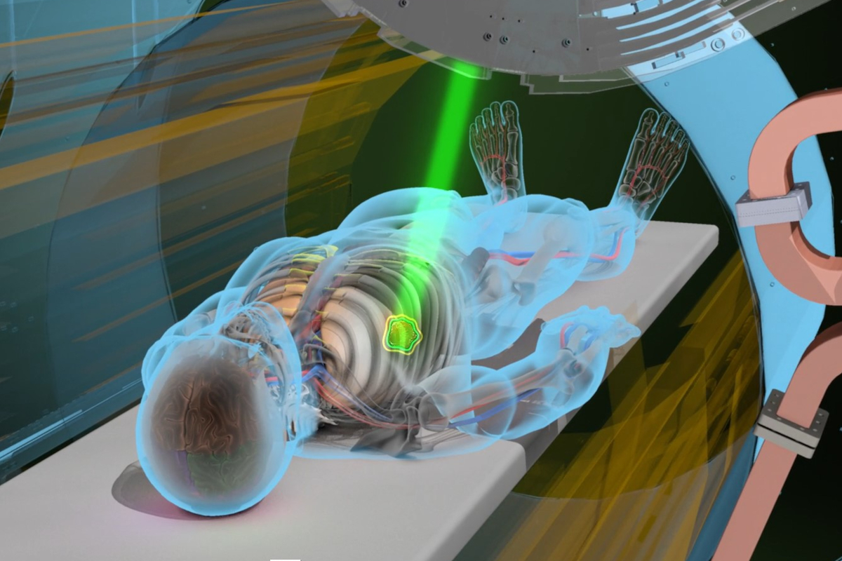 An animated image depicts a patient lying down and being treated with a beam of radiation from the MRIdian Radiation Therapy System.