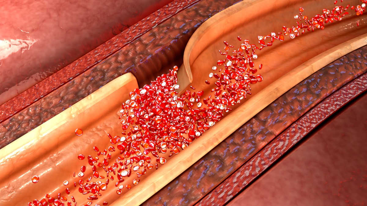 Illustration of an artery dissection.