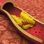 graphic depicts the cross-section of an artery with a substance on the artery wall representing cholesterol buildup.