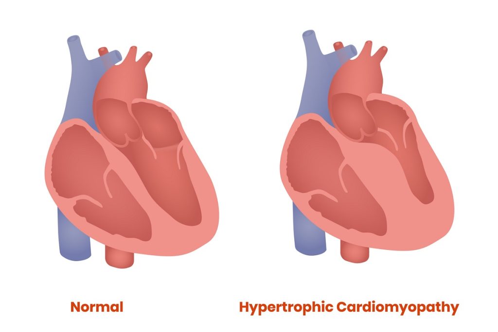 Normal heart and hypertrophic heart are shown in an illustration.