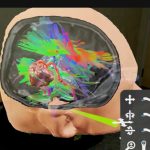 A computer screen view of a human head opened with graphics on the inside around the brain.