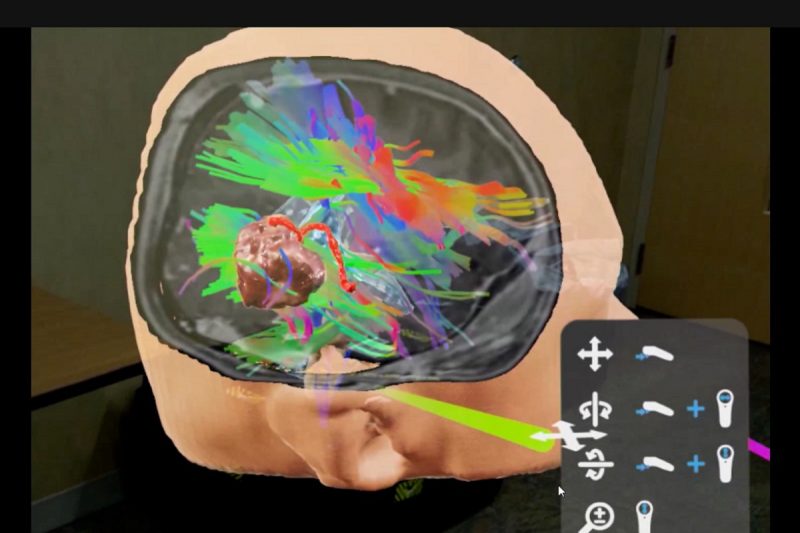 A computer screen view of a human head opened with graphics on the inside around the brain.