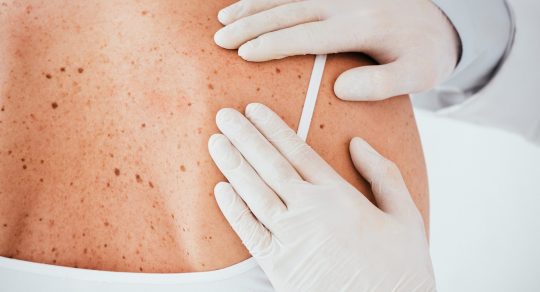 The Medical Minute: What to know about skin cancer