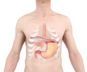 Medical illustration of person with full stomach and LINX metal beads around esophagus.