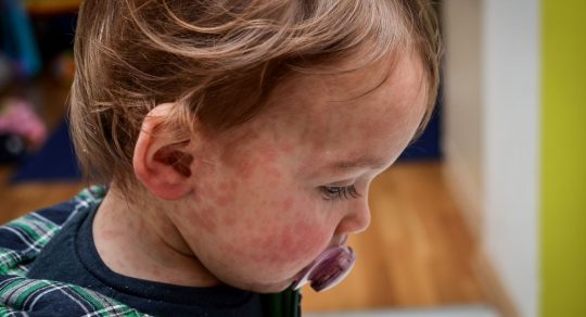 The Medical Minute: Measles makes a comeback. Your questions answered.