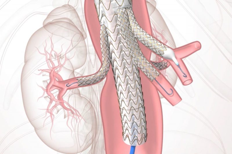A graphic rendering of a TAMBE device – a stent graft with branches – in place within a patient’s blood vessels.