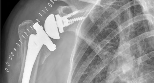 Risk indicators for hospital readmission after shoulder surgery in Pennsylvania
