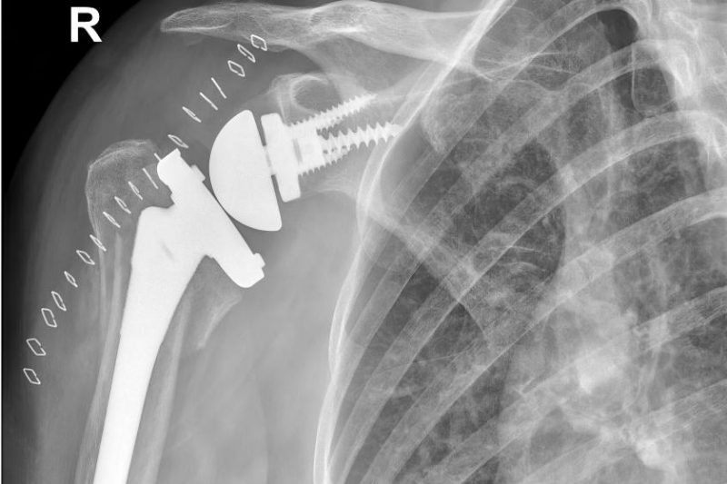 X-ray of a shoulder with a reverse shoulder replacement joint installed