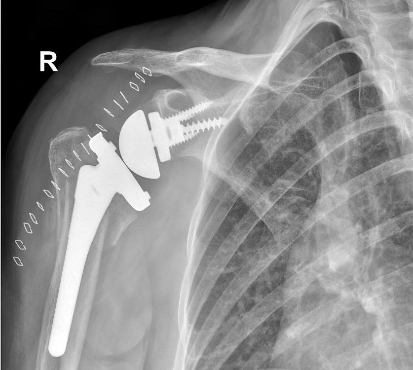 X-ray of a shoulder with a reverse shoulder replacement joint installed