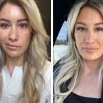 Before-and-after images show a woman with facial synkinesis. In the first image, her mouth pulls toward the upper-left. In the second image, her mouth is symmetrical.