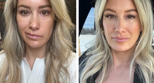 The Medical Minute: A tick bite left her face paralyzed. Specialized treatment helped her smile again