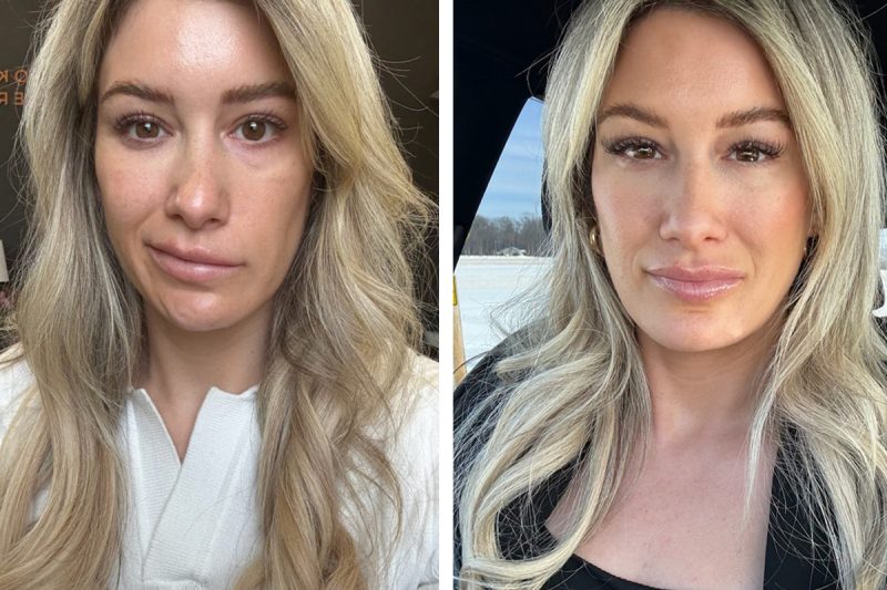 Before-and-after images show a woman with facial synkinesis. In the first image, her mouth pulls toward the upper-left. In the second image, her mouth is symmetrical.