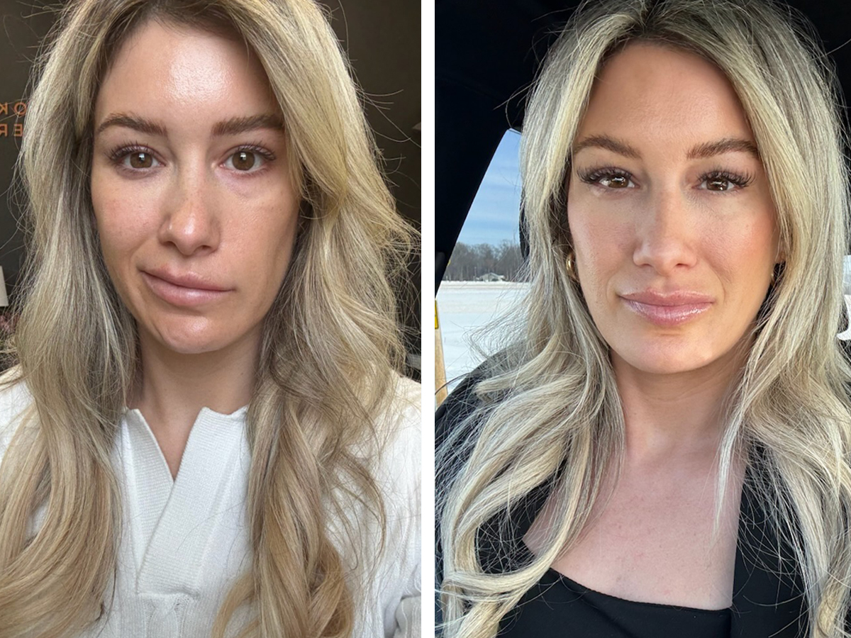 Before-and-after images show a woman with facial synkinesis. In the first image, her mouth pulls toward the upper-left. In the second image, her mouth is symmetrical.